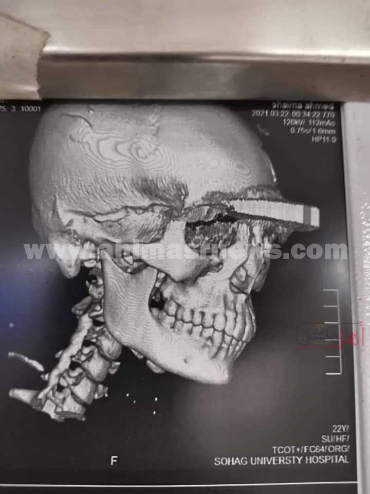 صورة أشعة ربة منزل ضربتها ضرتها بالساطور في قنا